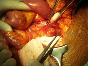 Dilatación de la aorta